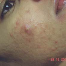 before acne